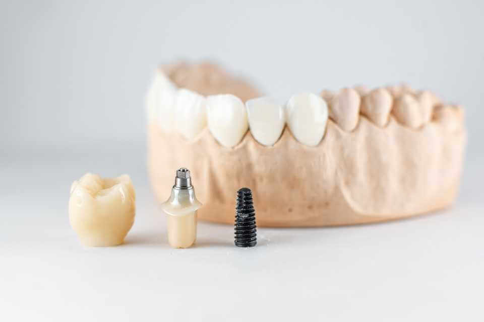 Implanty zębowe od A do Z