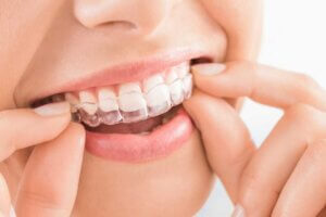 System ortodontyczny Invisalign