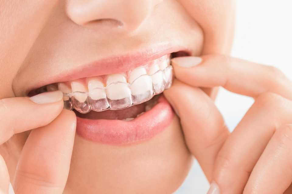 System ortodontyczny Invisalign