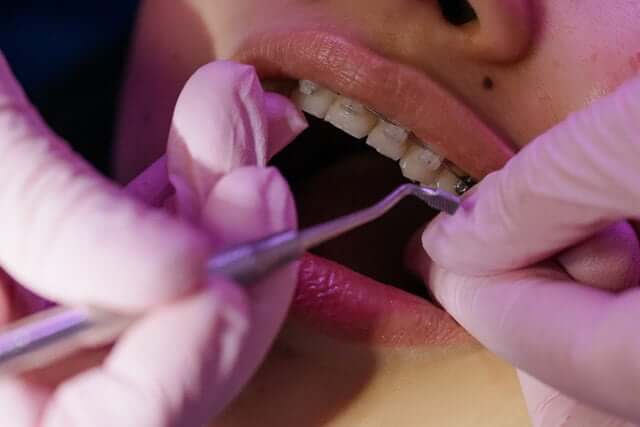 Ortodonta Radom poleca aparaty ortodontyczne