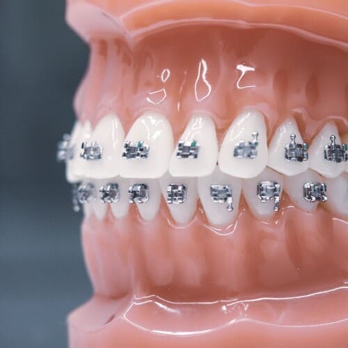 Ortodonta Radom - aparat ortodontyczny