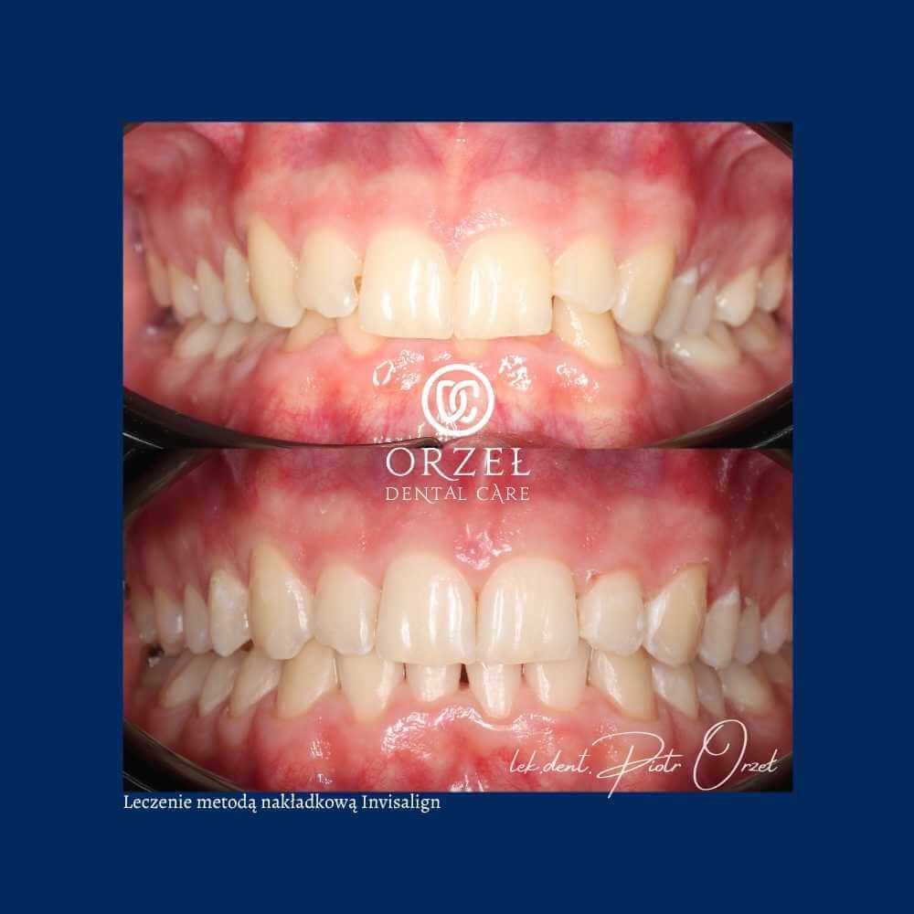 Efekt leczenia ortodontycznego - Orzeł Dental Care - Radom