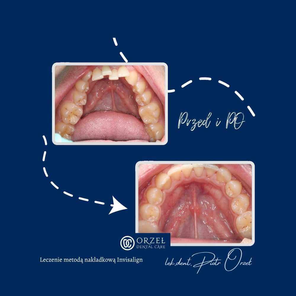 Efekt leczenia ortodontycznego - Orzeł Dental Care - Radom