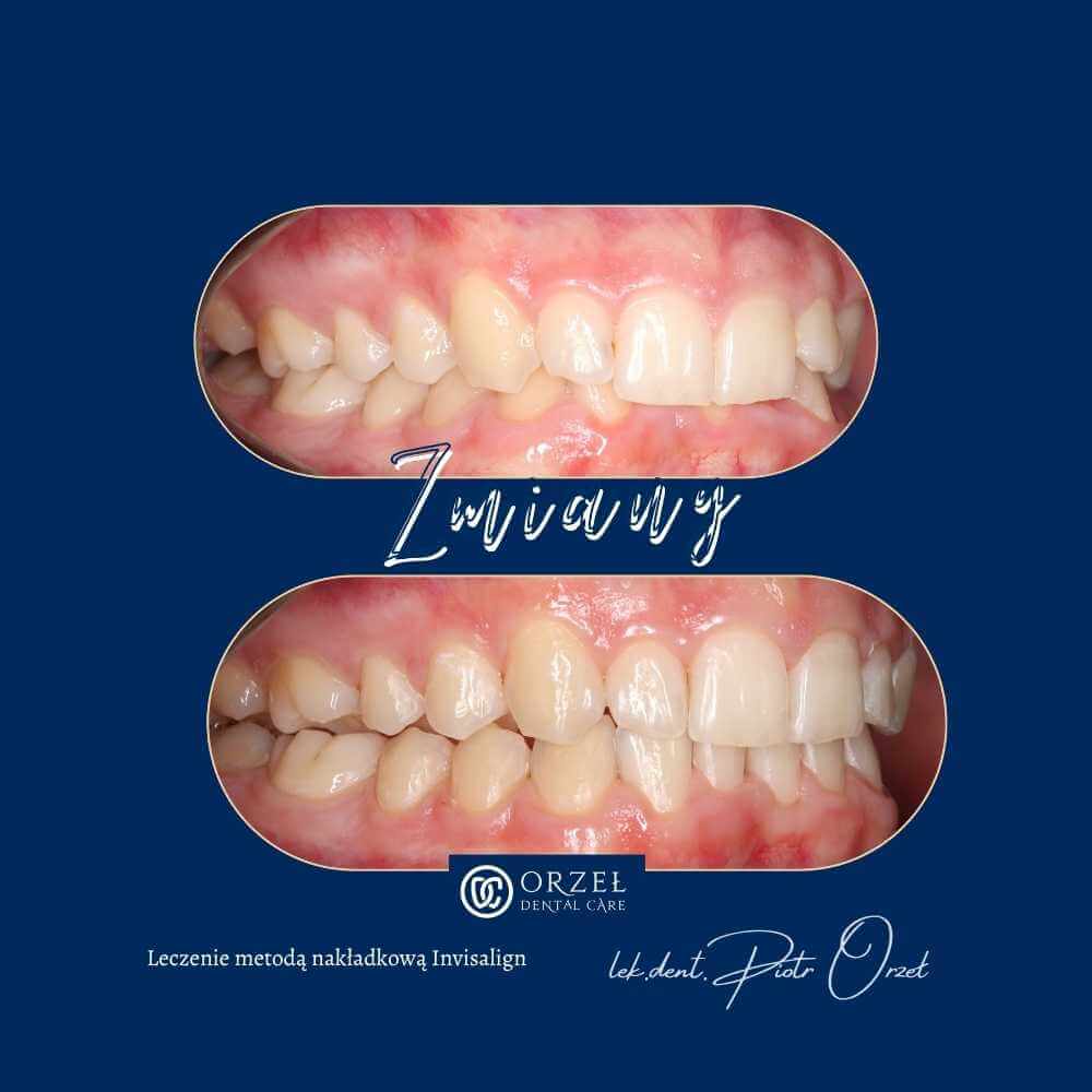 Efekt leczenia ortodontycznego - Orzeł Dental Care - Radom