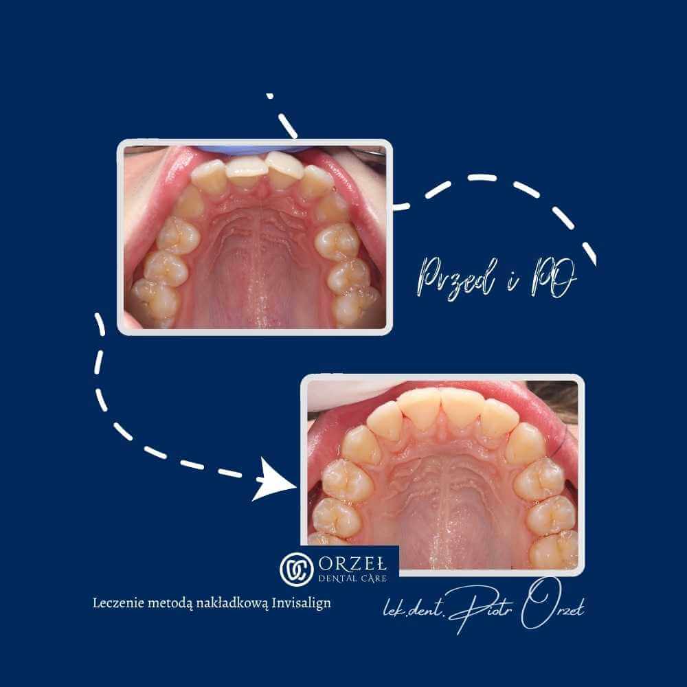 Efekt leczenia ortodontycznego - Orzeł Dental Care - Radom