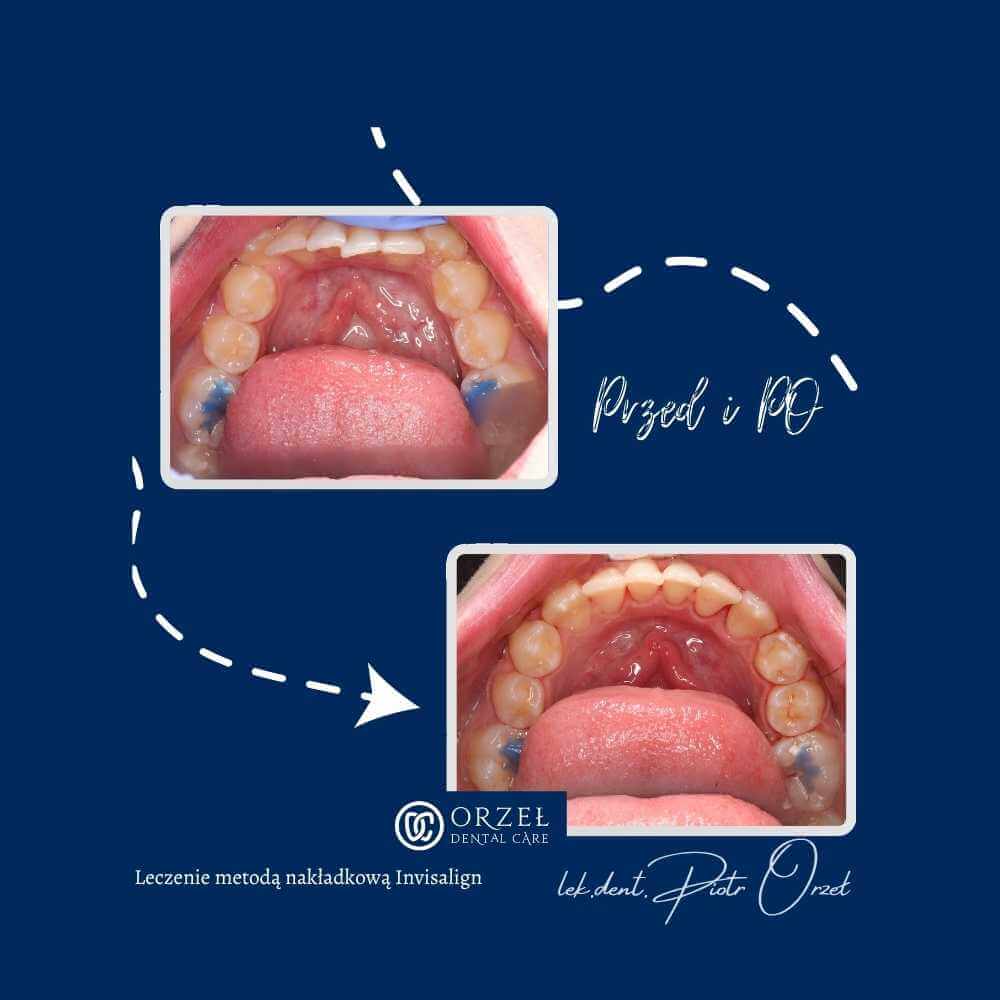 Efekt leczenia ortodontycznego - Orzeł Dental Care - Radom
