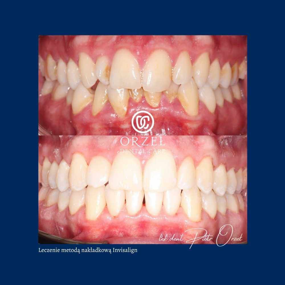 Efekt leczenia ortodontycznego - Orzeł Dental Care - Radom