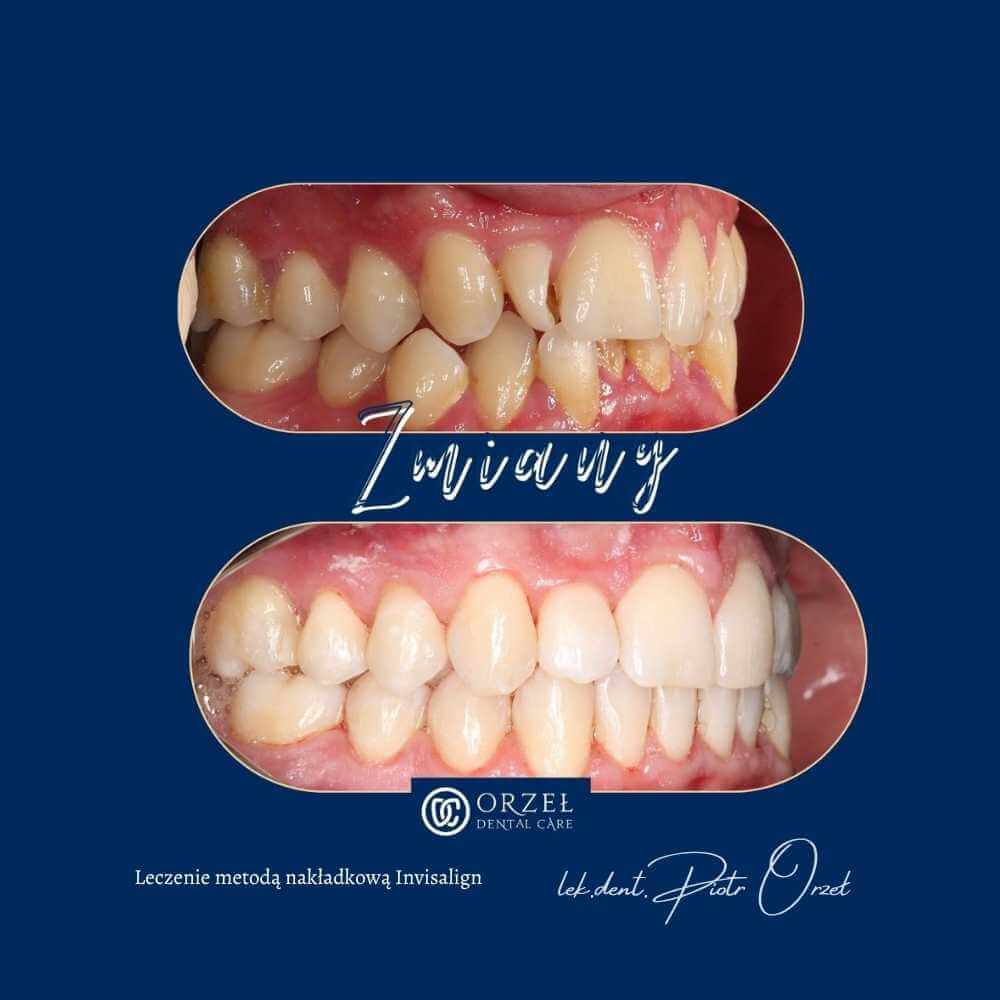 Efekt leczenia ortodontycznego - Orzeł Dental Care - Radom