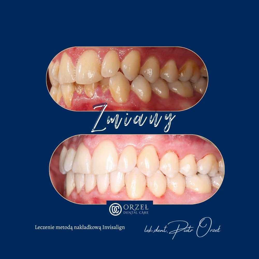Efekt leczenia ortodontycznego - Orzeł Dental Care - Radom