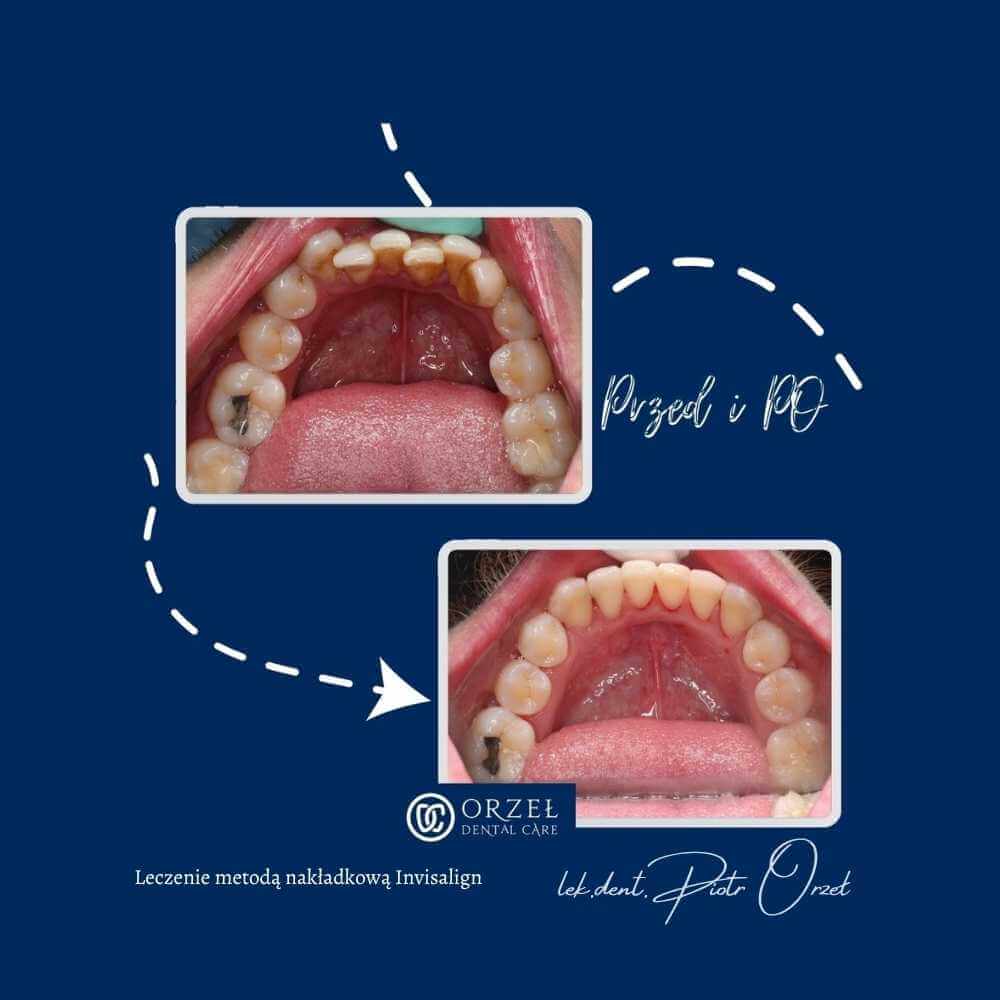 Efekt leczenia ortodontycznego - Orzeł Dental Care - Radom