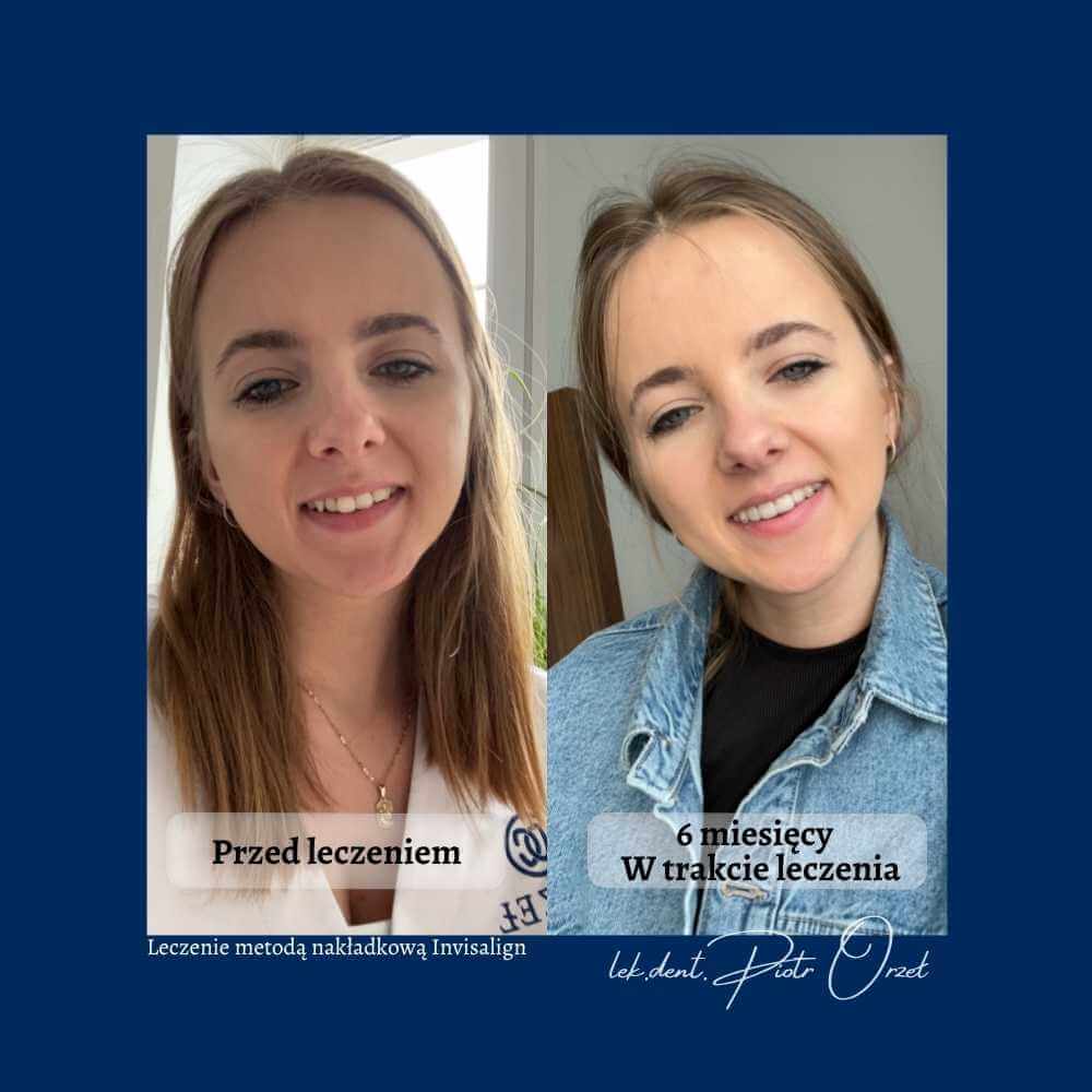 Efekt leczenia ortodontycznego - Orzeł Dental Care - Radom