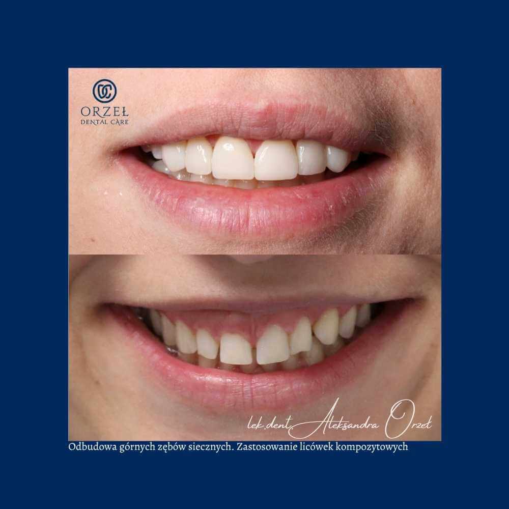Efekt leczenia protetycznego - Orzeł Dental Care - Radom
