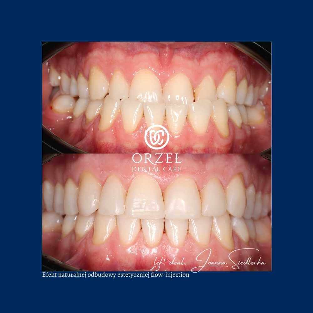 Efekt leczenia protetycznego - Orzeł Dental Care - Radom
