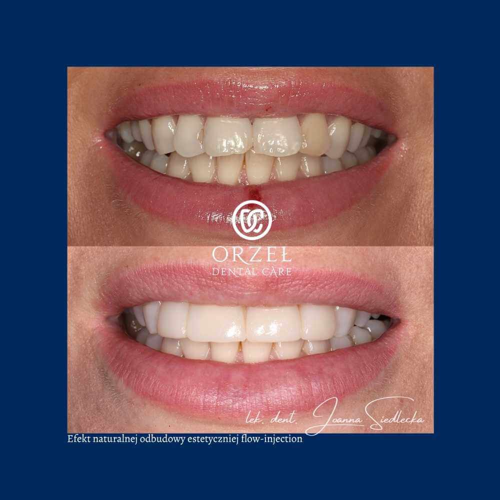 Efekt leczenia protetycznego - Orzeł Dental Care - Radom