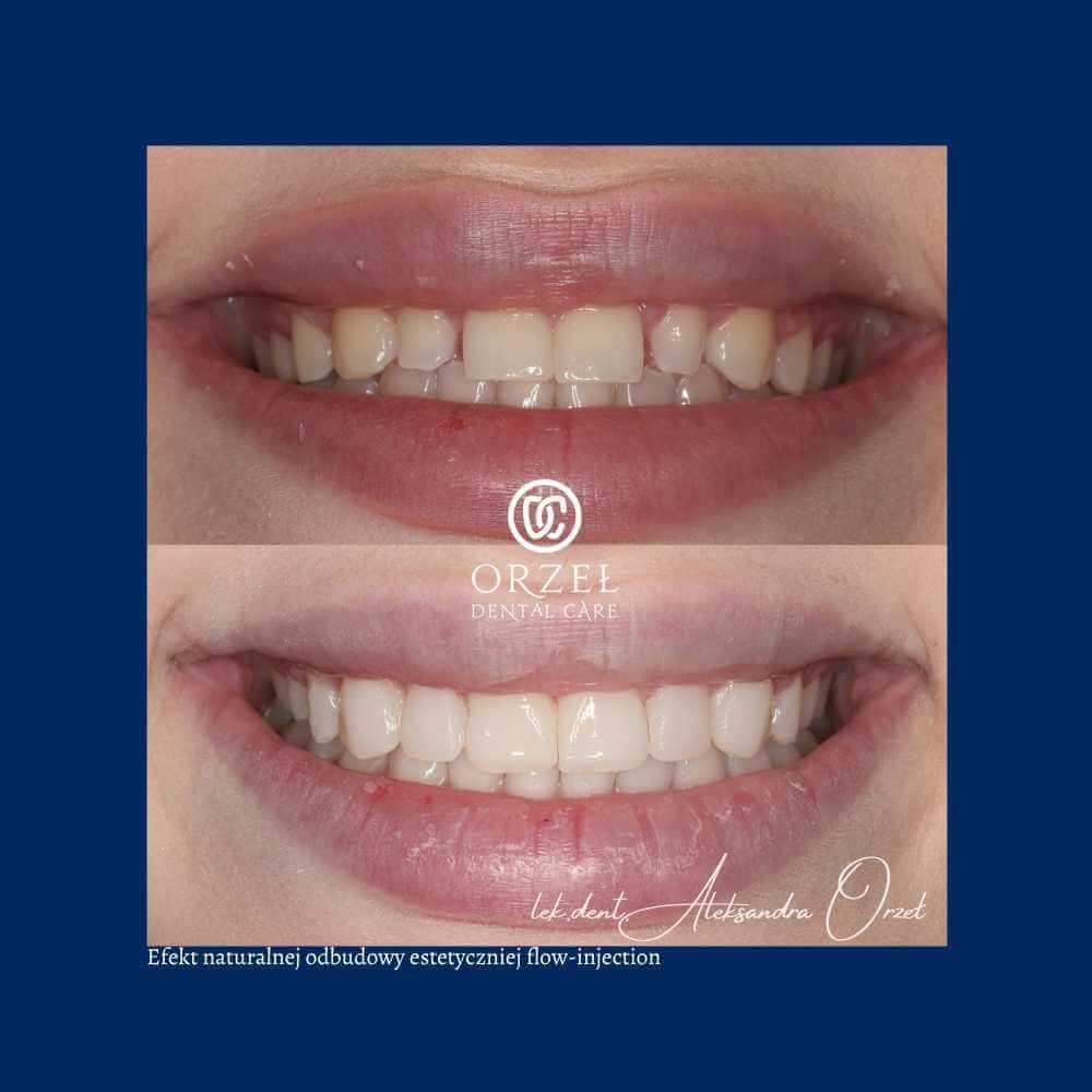 Efekt leczenia protetycznego - Orzeł Dental Care - Radom