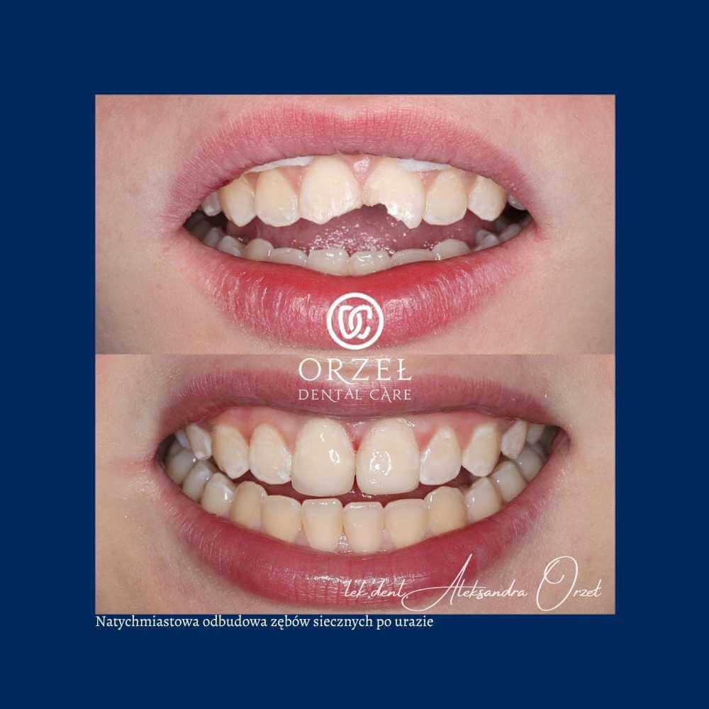 Efekt leczenia protetycznego - Orzeł Dental Care - Radom