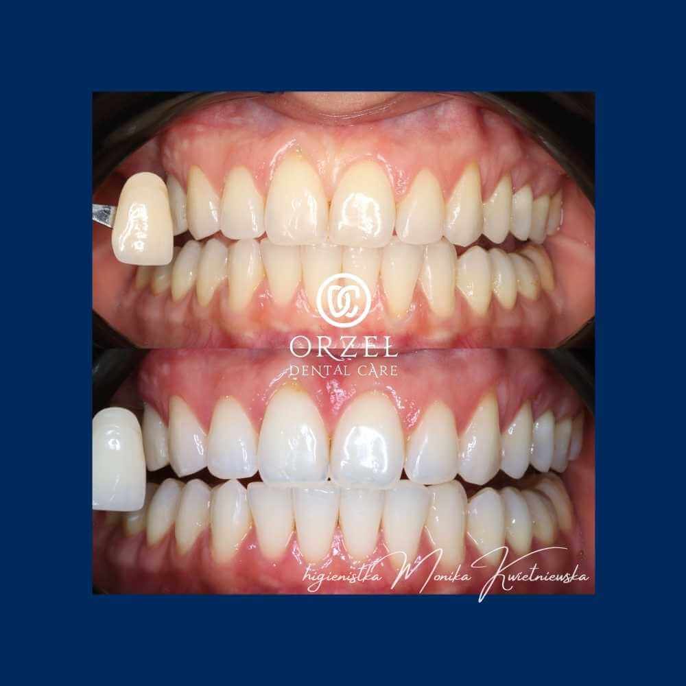 Efekt wybielania zębów - Orzeł Dental Care - Radom