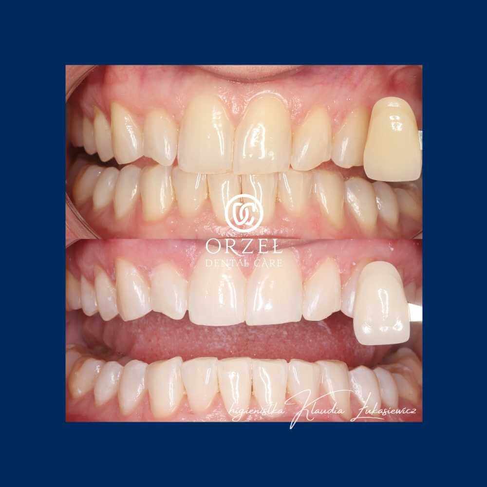 Efekt wybielania zębów - Orzeł Dental Care - Radom