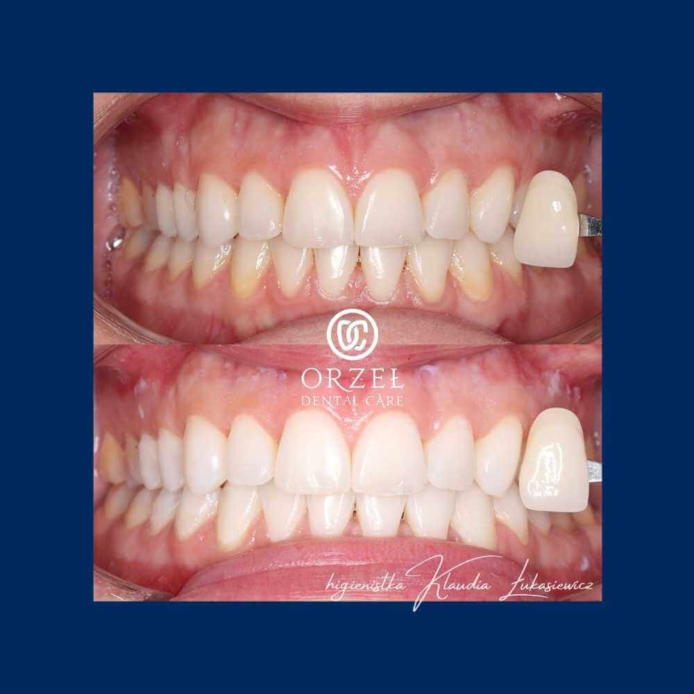 Efekt wybielania zębów - Orzeł Dental Care - Radom