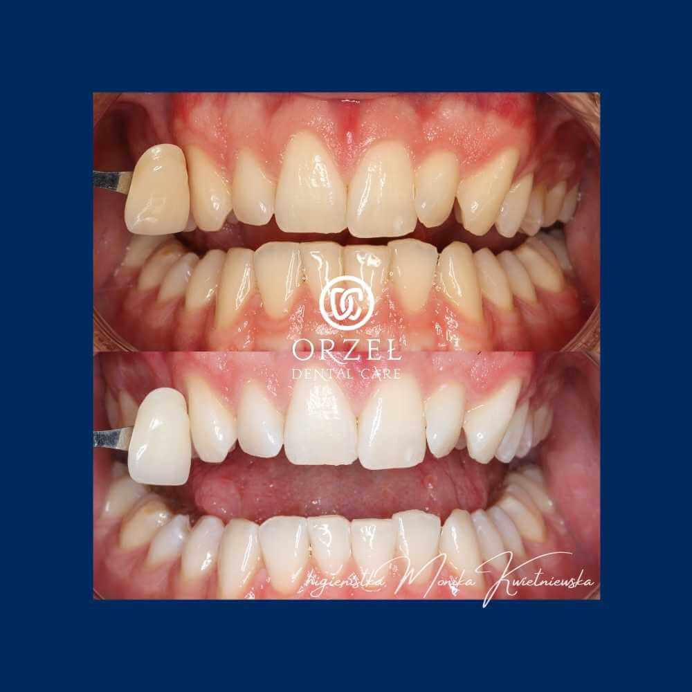 Efekt wybielania zębów - Orzeł Dental Care - Radom