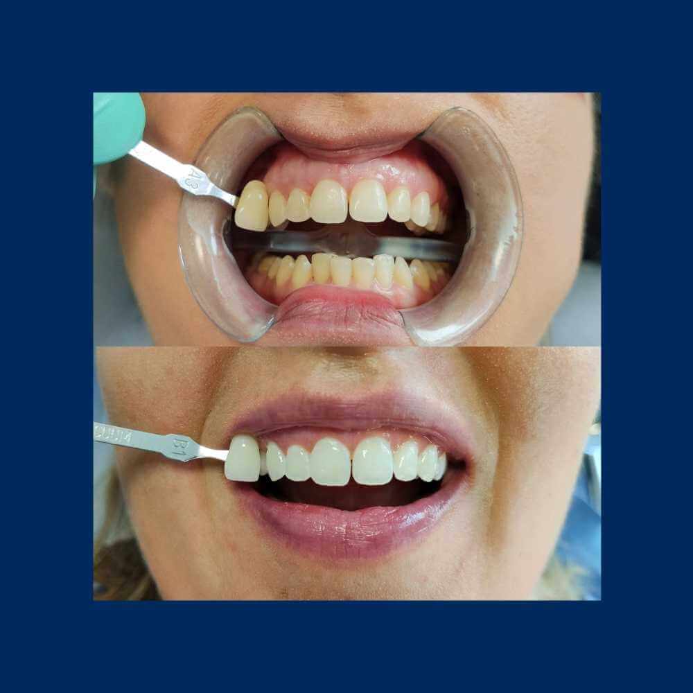 Efekt wybielania zębów - Orzeł Dental Care - Radom