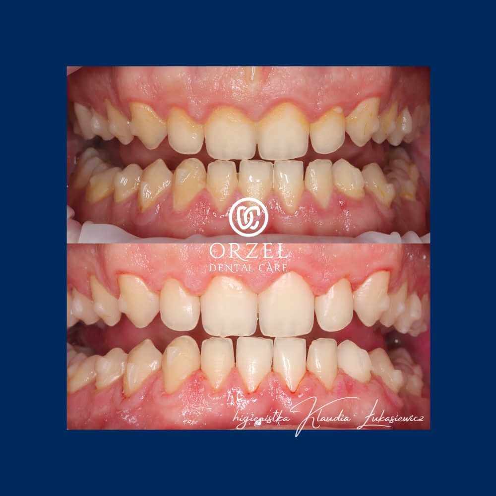Efekt higienizacji - Orzeł Dental Care - Radom