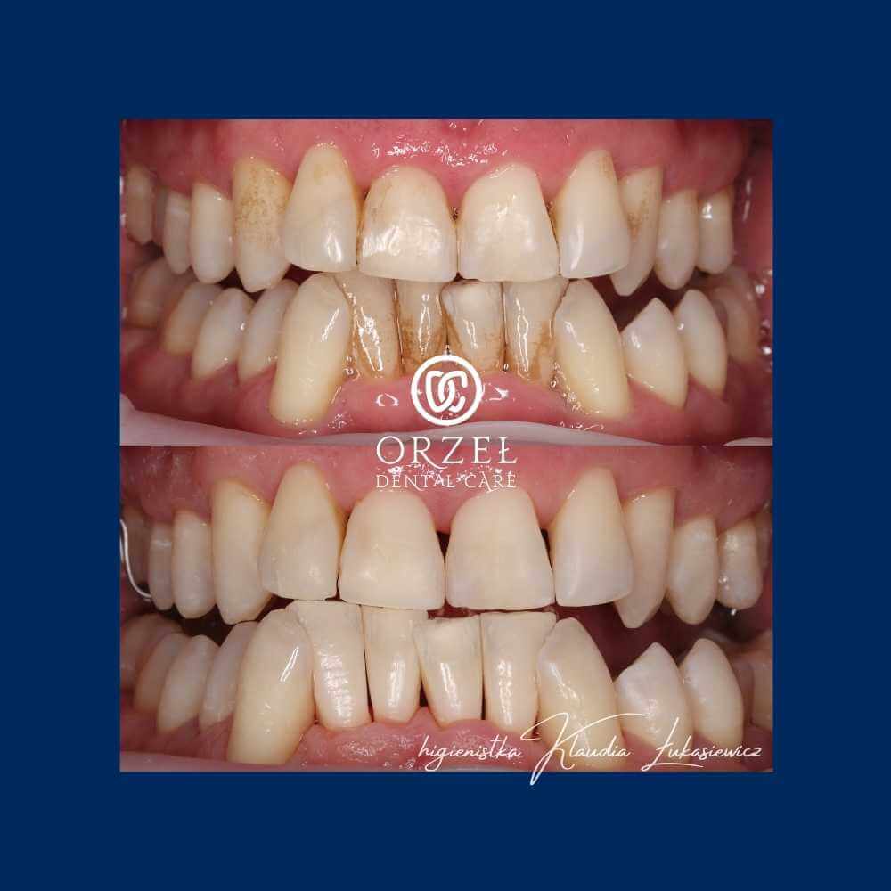 Efekt higienizacji - Orzeł Dental Care - Radom
