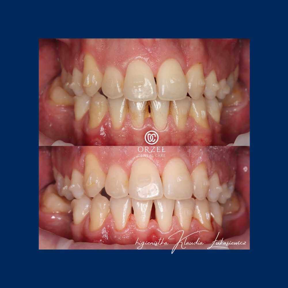 Efekt higienizacji - Orzeł Dental Care - Radom