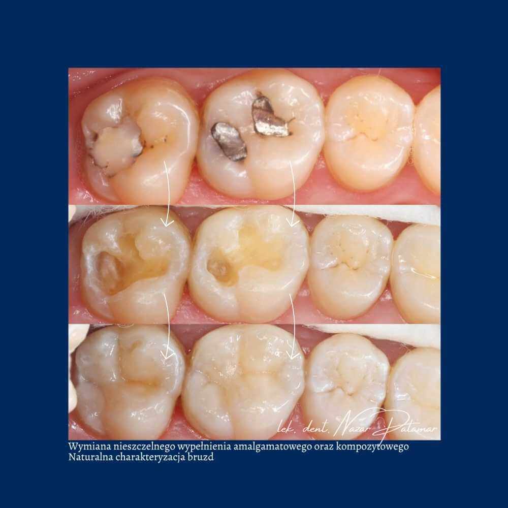 Efekt leczenia zachowawczego - Orzeł Dental Care - Radom