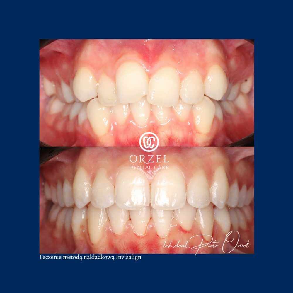 Efekt leczenia ortodontycznego - Orzeł Dental Care - Radom