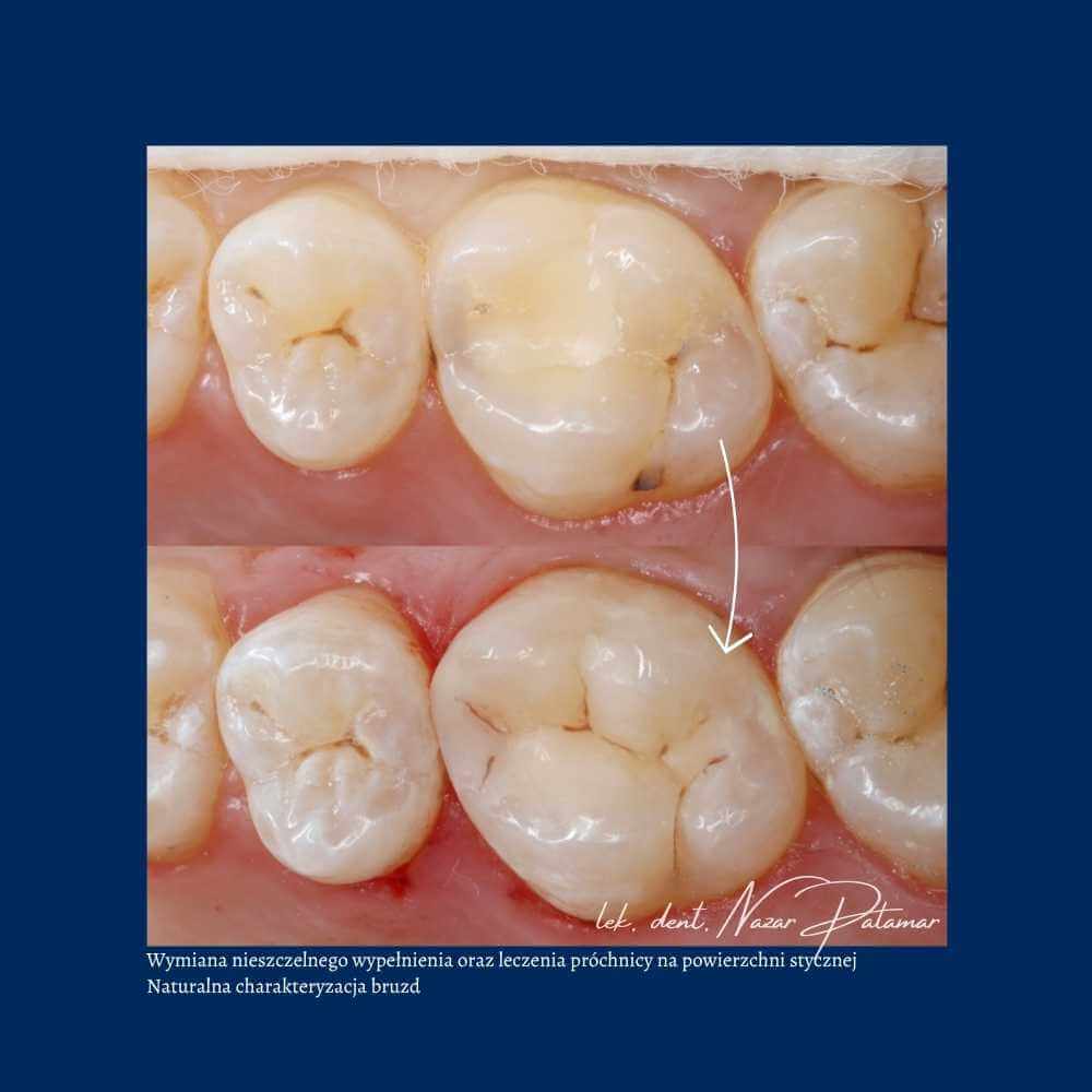 Efekt leczenia zachowawczego - Orzeł Dental Care - Radom