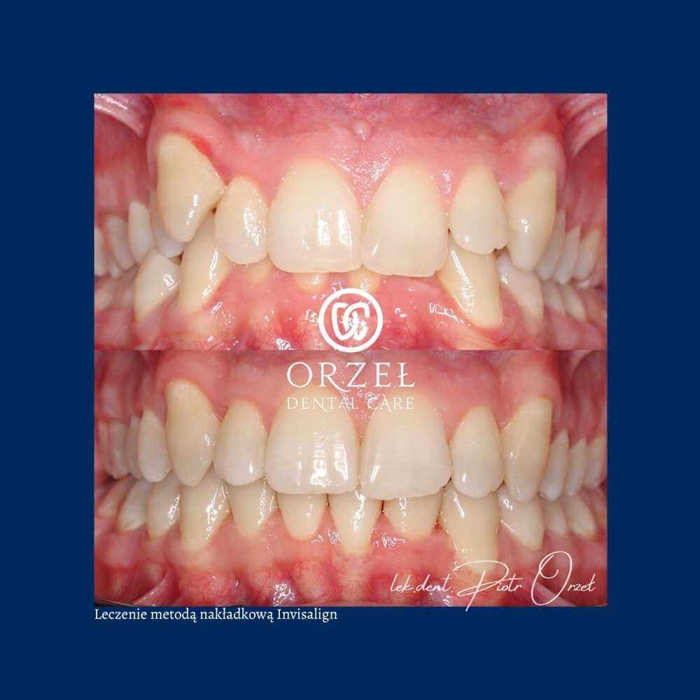 Efekt leczenia ortodontycznego - Orzeł Dental Care - Radom