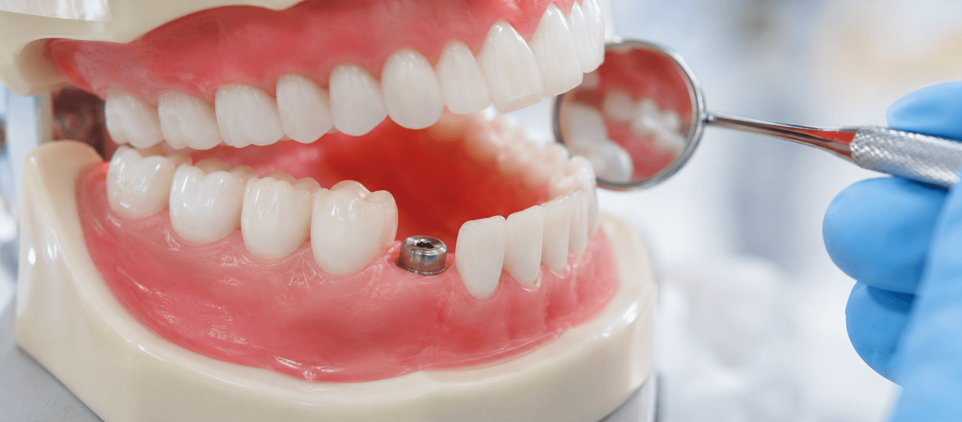 Śruba gojąca implant