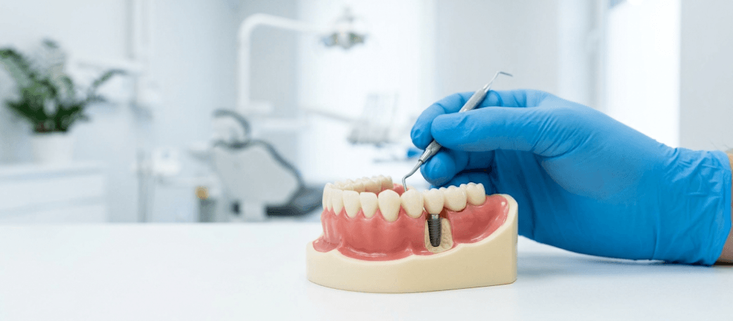 jak uzupełnić brak tylnych zębów - implant zębowy