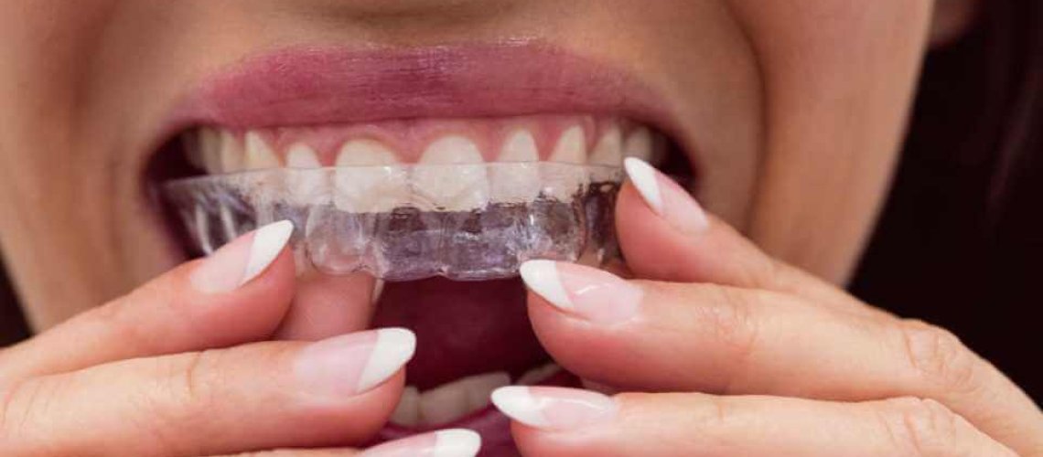 Nakładki Invisalign na zęby – jak często je zmieniać Kobieta wymieniająca nakładki na zęby