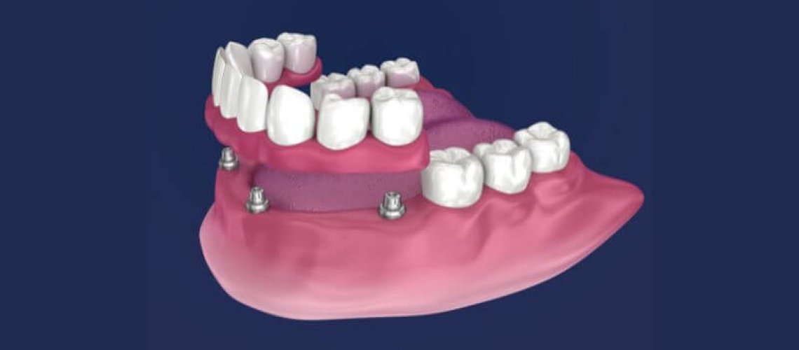 Proteza overdenture